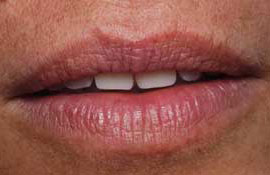 Restore tooth positions
