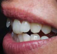 Restore tooth positions