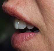 Restore tooth positions
