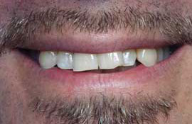 Bite correction