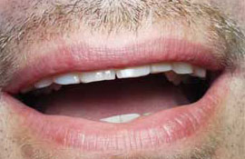 Bite correction