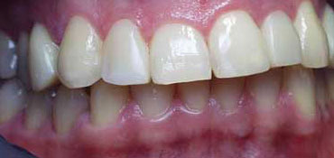 Bite correction