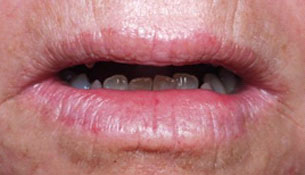 Open bite treatment