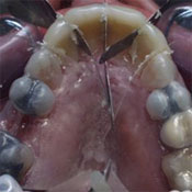 Open bite treatment