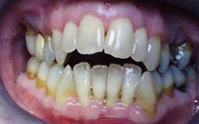 Open bite treatment
