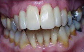 Open bite treatment