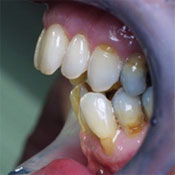 Open bite treatment