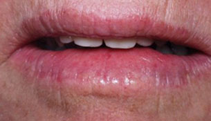 Open bite treatment