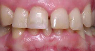 Poor restorations