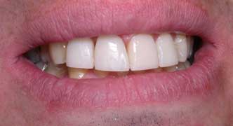 Poor restorations