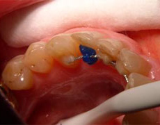 bracket fixation