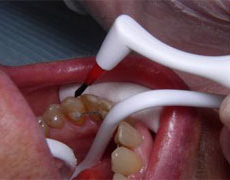 bracket fixation