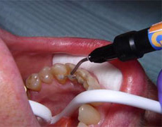 bracket fixation