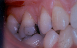 Posterior Restauration Procedure