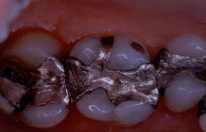 Posterior Restauration Procedure