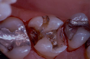 Posterior Restauration Procedure