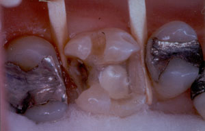 Posterior Restauration Procedure