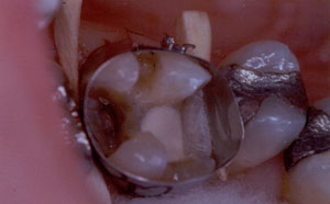 Posterior Restauration Procedure