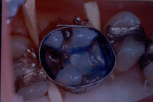 Posterior Restauration Procedure