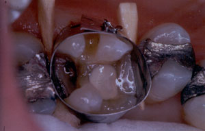 Posterior Restauration Procedure