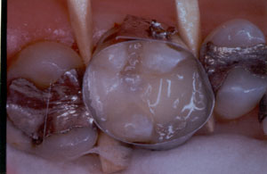 Posterior Restauration Procedure