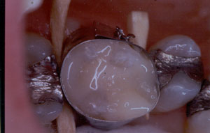 Posterior Restauration Procedure