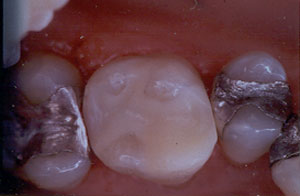 Posterior Restauration Procedure