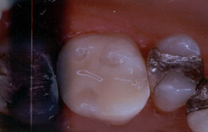 Posterior Restauration Procedure