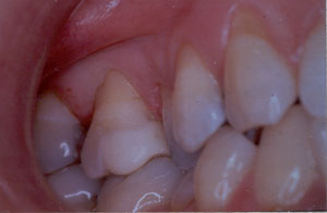 Posterior Restauration Procedure