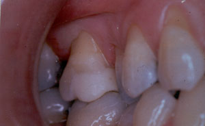 Posterior Restauration Procedure
