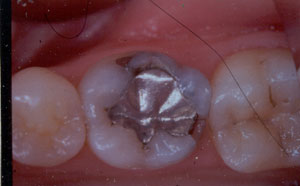 Posterior Restauration Procedure