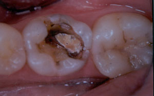 Posterior Restauration Procedure