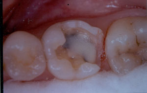 Posterior Restauration Procedure