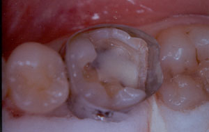 Posterior Restauration Procedure