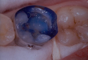 Posterior Restauration Procedure