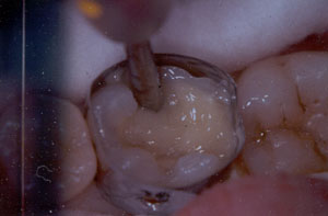 Posterior Restauration Procedure