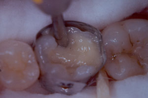 Posterior Restauration Procedure
