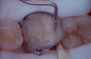 Posterior Restauration Procedure