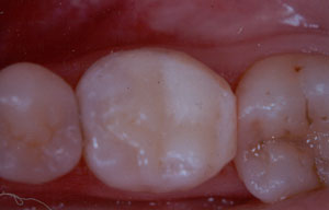 Posterior Restauration Procedure