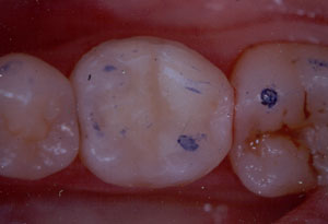 Posterior Restauration Procedure