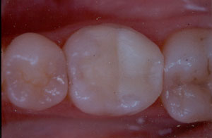 Posterior Restauration Procedure