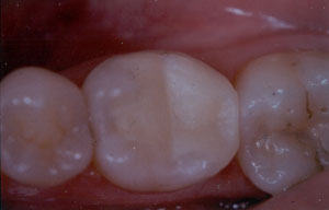 Posterior Restauration Procedure