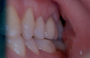 Posterior Restauration Procedure