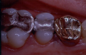 Posterior Restauration Procedure