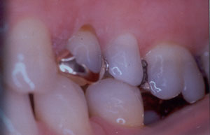 Posterior Restauration Procedure