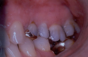 Posterior Restauration Procedure