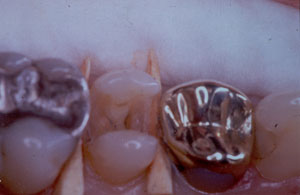 Posterior Restauration Procedure