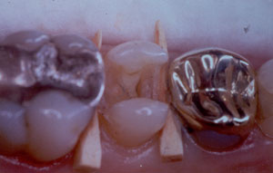 Posterior Restauration Procedure