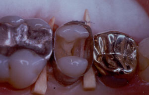 Posterior Restauration Procedure