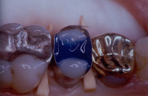 Posterior Restauration Procedure